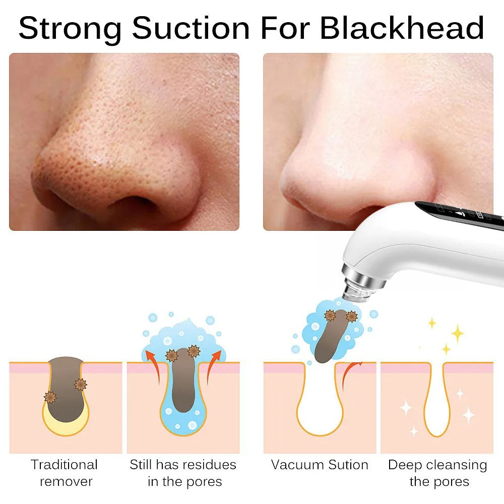 PoreClean™ Blackhead Remover Vacuum